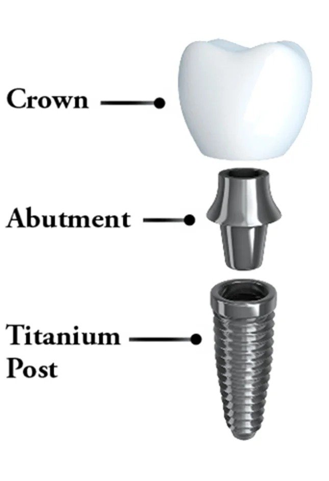 Dental implant structure showing crown, abutment and titanium implant post