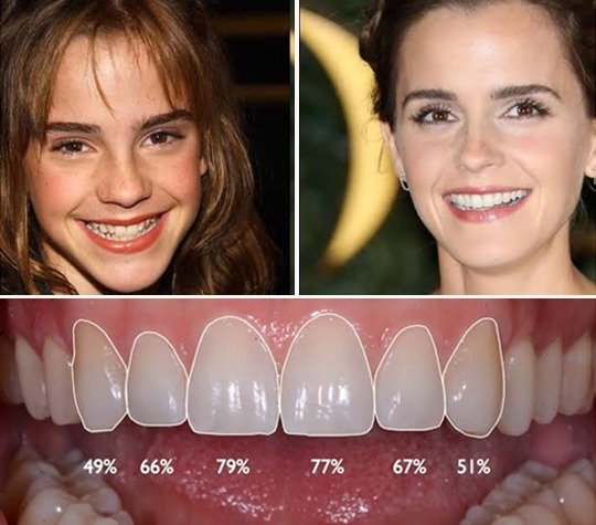 Smile design and dental veneers cosmetic transformation