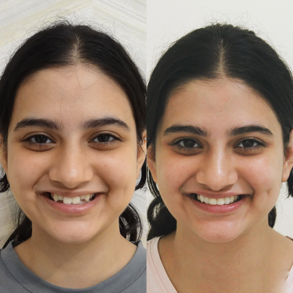 Dental Implant Cost in Bangalore: Cost, Pain After Implant & How Long Implants Last