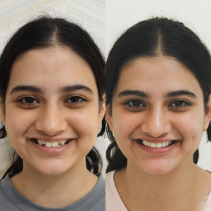 Smile design and dental veneers cosmetic transformation