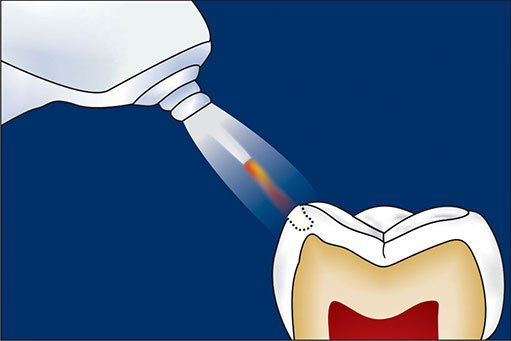 laser root canal treatment cleaning bacteria deep infection